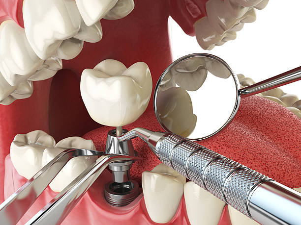 Best Emergency Treatment for Dental Infections or Abscesses in Morrisville, NC